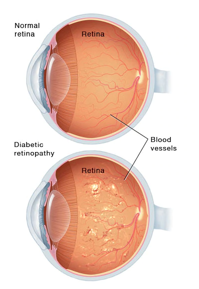 Diyabetik retinopatinin erken evrelerinde, retinadaki kan damarlarının duvarları zayıflar. Küçük şişkinlikler damar duvarlarından taşar, bazen sıvı ve kanın retinaya sızması veya sızması. Retinadaki sinir lifleri, retinada beyaz lekeler oluşturarak şişebilir. Diyabetik retinopati ilerledikçe, yeni kan damarları büyüyebilir ve görüşünüzü tehdit edebilir.